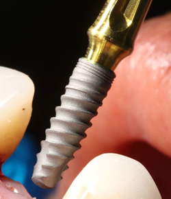 Implantes Dentales Dr. Mauricio Torres - Cali Colombia